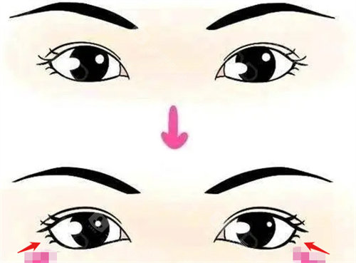 眼睑下至前后对比图.jpg