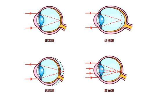 远视眼和近视眼的区别