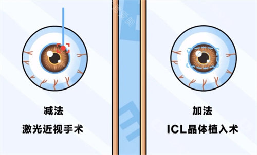 近视手术的分类