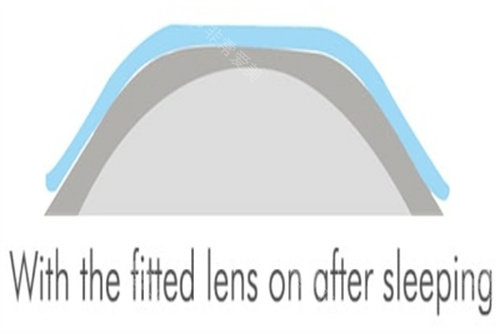 重庆南坪爱尔陈春梅医生怎么样?20余年小儿眼科经验_近视防控+角膜塑形镜验配!