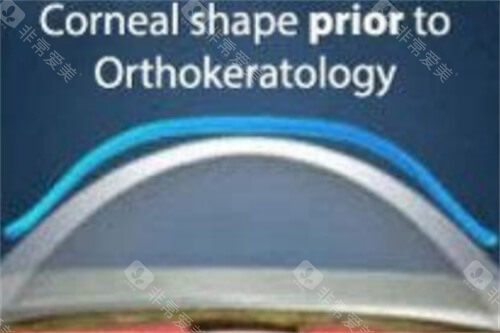 角膜塑形镜4