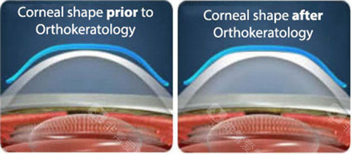 重庆小儿近视防控哪家好?南坪爱尔陈春梅/杨和平医生_斜弱视矫正+角膜塑形镜验配!