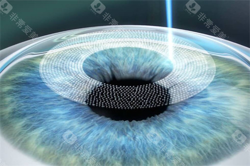 激光近视眼手术大概多少钱?2026年激光近视手术价格表8800元起,不同近视手术术式价目表一览! 