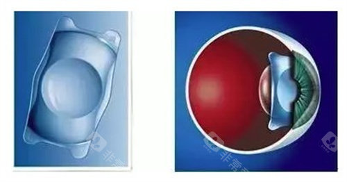 老花眼晶体置换手术