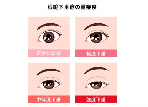 重庆病理性眼整形哪家好?南坪爱尔毕玉玲医生_20余年经验_眼睑眼眶病诊疗正规!