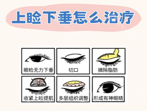 上睑下垂治疗漫画图
