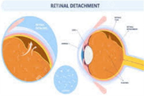 重庆眼底病诊疗哪家好?南坪爱尔桂君民/张奕霞医生_小创口玻切+视网膜疾病治疗!