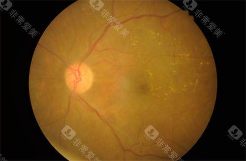 视网膜色素变性示意图