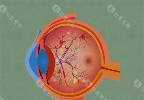 视网膜色素变性的眼睛