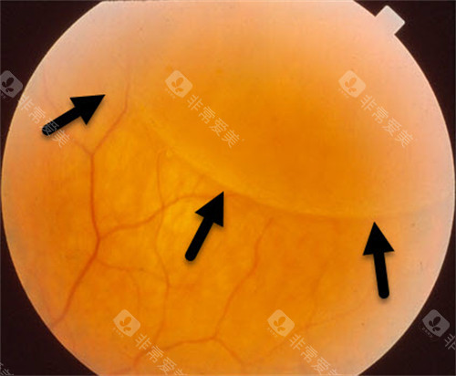 视网膜劈裂图示