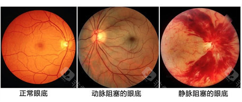 眼底检查的重要性