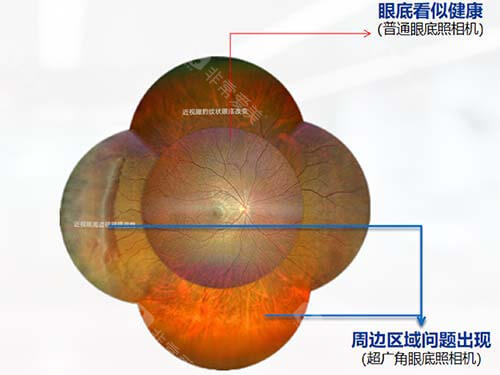 超广角眼底照相机对比普通眼底相机眼底差别漫画图