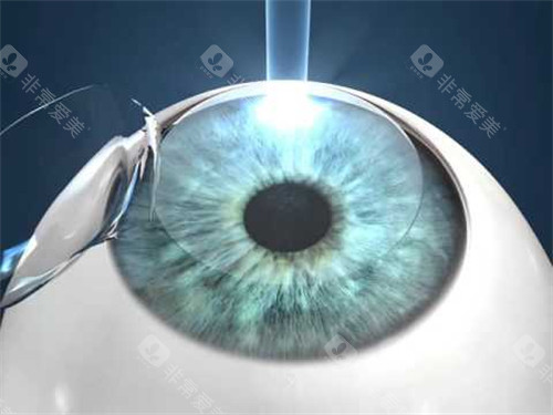 人工晶体植入眼睛图示