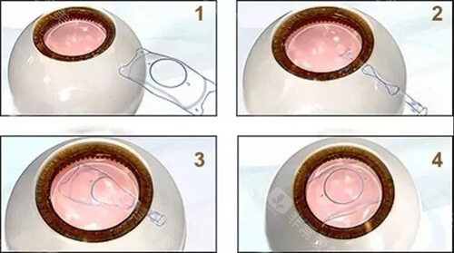 长沙裕湘医院王华医师怎么样?省人民医院医师_激光/晶体植入手术口碑爆棚!