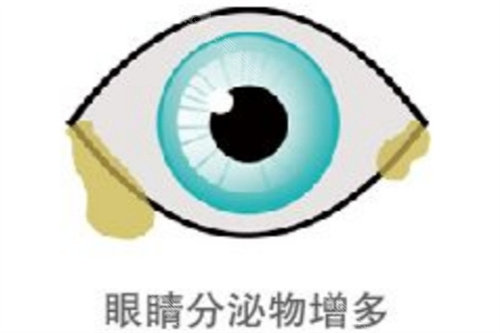 眼睛分泌物增多示意图