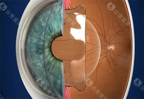 双焦晶体植入的总费用是多少？双眼2.2w元起， 双焦点人工晶体优缺点