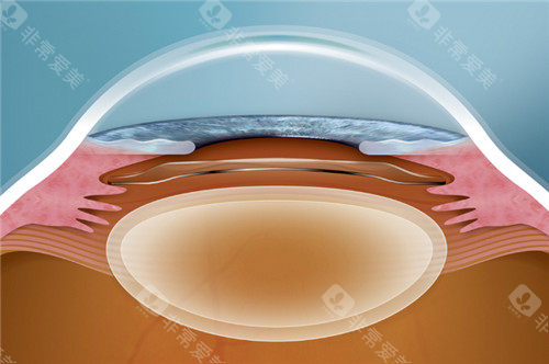 晶体植入手术动画图