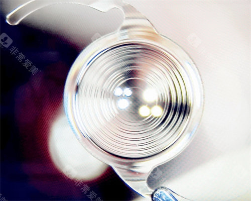 跃无极晶体植入后体验感受：术后第二天视力1.0视觉清晰，夜间光圈问题3个月消失！