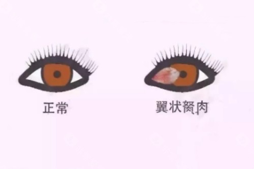 翼状胬肉必须手术吗？遮盖瞳孔或影响视力时必须手术！