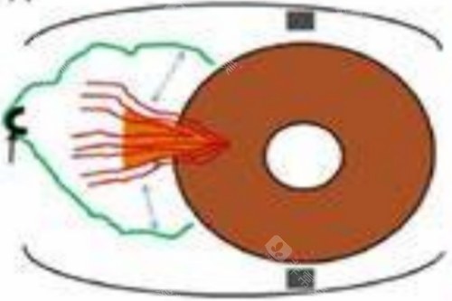 翼状胬肉示意图