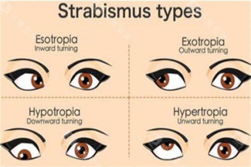 不同斜视对比图