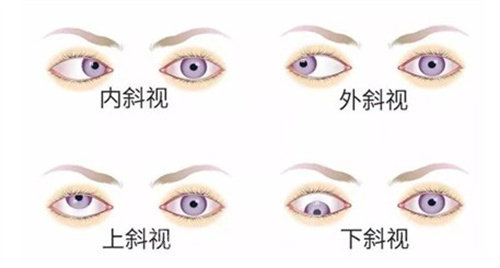 内外斜视、上下斜视