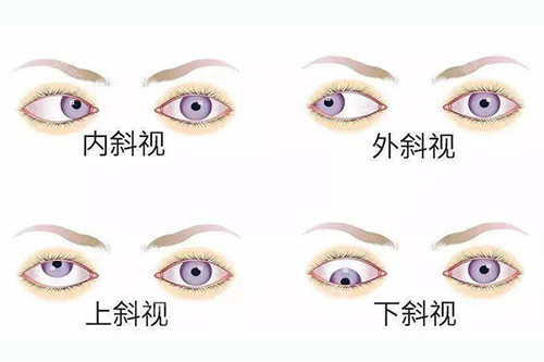 眼睛斜视不同类型分享