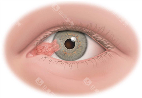翼状胬肉眼睛
