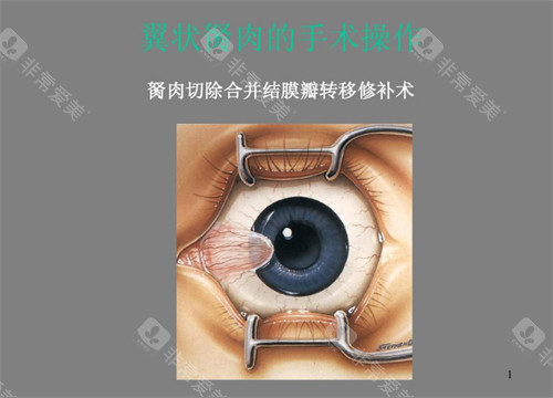 翼状胬肉