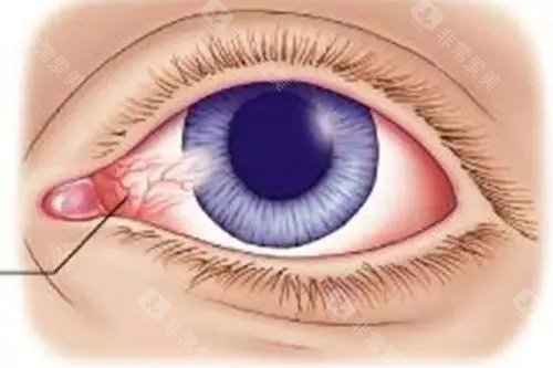 翼状胬肉手术费用：普通切除3000+，加羊膜移植8000+