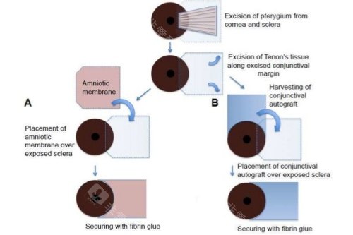 翼状胬肉治疗示意图