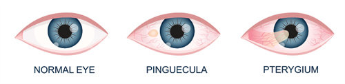 翼状胬肉的眼睛