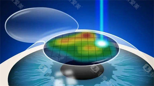 个性化微飞秒手术过程图片