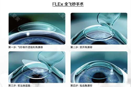 全飞秒手术过程示意图