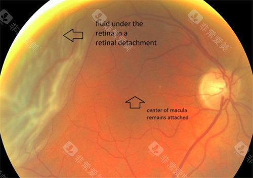 视网膜脱落检查