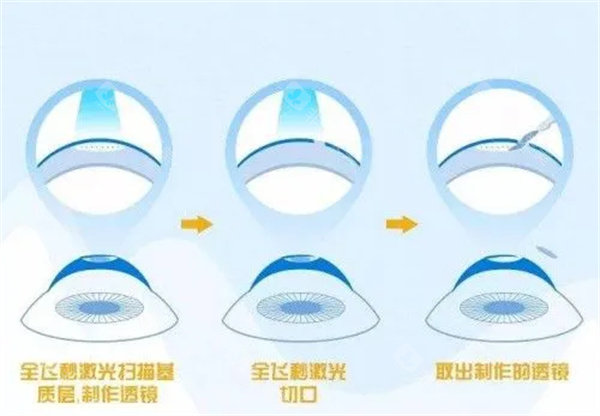 乌鲁木齐空军眼科医院收费标准公布，近视矫正8800起/白内障5200起/青光眼4000起！