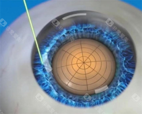 飞秒激光白内障手术图