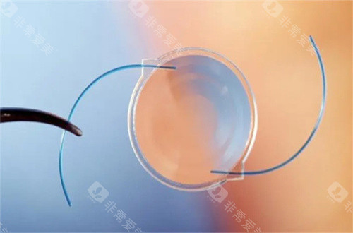 白内障人工晶体