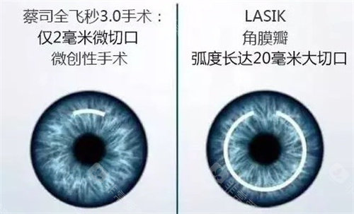 蔡司全飞秒3.0手术和LASIK对比