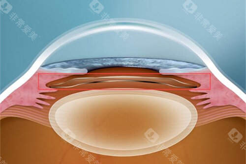 icl晶体植入眼睛漫画图