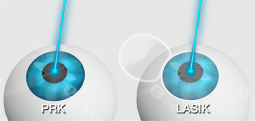 不同的近视手术