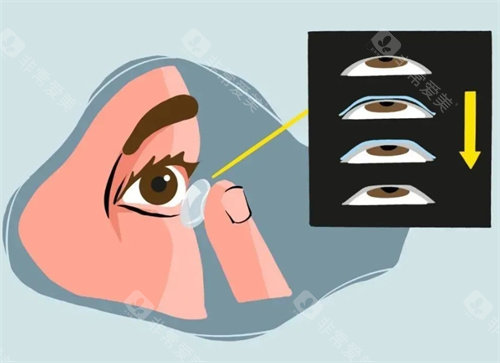 北京明日眼科OK镜验配靠谱吗？医生经验足+术后随访及时，防控成效显著，家长认可