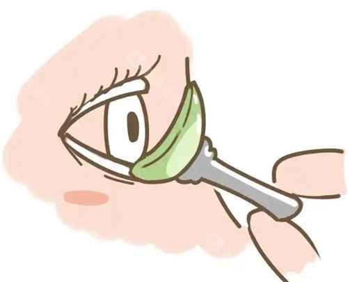 迈儿康ok镜的佩戴过程