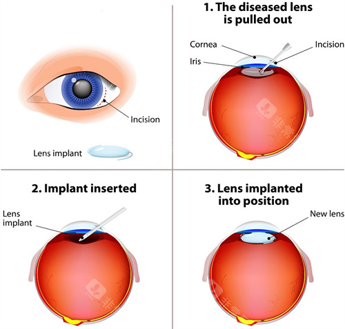 晶体植入手术过程