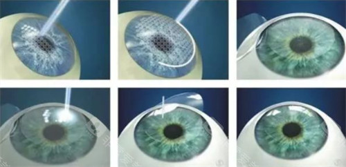 中山大学海南眼科医院收费价格表:近视眼9980元起、白内障6000元起、青光眼6800元起