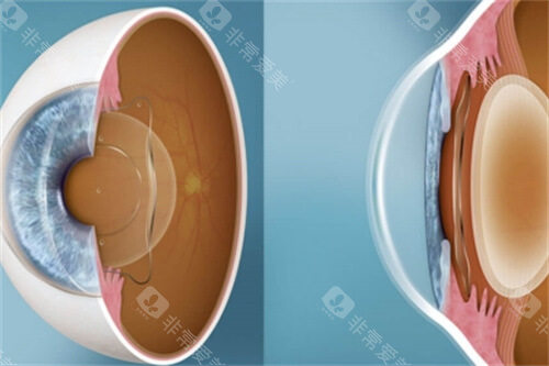 重庆西南医院眼科近视手术价格表:半飞秒1万元起、全飞秒1.8万元起、ICL晶体植入3.5万元起 