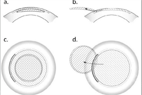 哈尔滨普瑞眼科医院全飞秒价格是多少钱？全飞秒手术价格是16500元起！