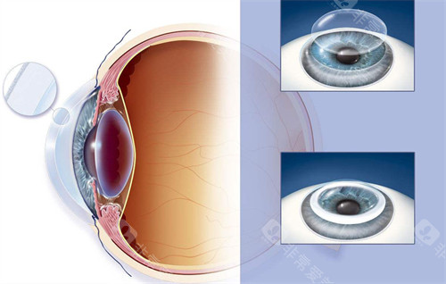 网选江门角膜移植医院排名榜:五邑爱尔新希望眼科|光明眼科|鹤山爱尔新希望眼科口碑好! 