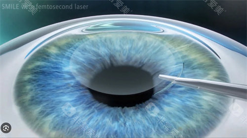 湖南航天医院眼科收费价格表:近视眼/白内障/角膜塑形镜/老花眼/青光眼价目表公布! 