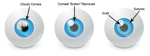 重庆西南医院治疗角膜移植手术费用是多少？不同来源的角膜价格差很多！